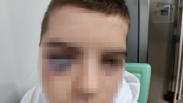 ДЕЧАКУ ОКО МОДРО И ЗАТВОРЕНО: Отац из Сурдулице пријавио да му је дете (15) жртва вршњачког насиља (ФОТО)