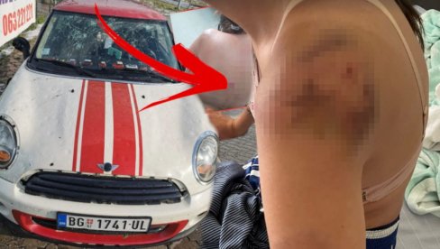ИЗУБИЈАНА И СВА У МАСНИЦАМА: Доктор јој није веровао да су повреде од града - Ивана објавила слике након суперћелијске олује (ФОТО) ИЗУБИЈАНА И СВА У МАСНИЦАМА: Доктор јој није веровао да су повреде од града - Ивана објавила слике након суперћелијске олује (ФОТО)