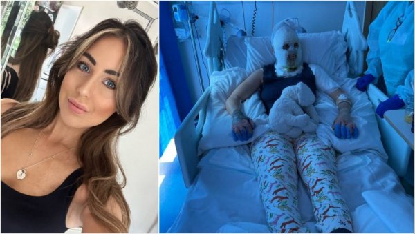 ГРЕЈАЛИЦА ЈОЈ ЕКСПЛОДИРАЛА У ЛИЦЕ: Девојка задобила језиве повреде, лекари морали да је уведу у кому ГРЕЈАЛИЦА ЈОЈ ЕКСПЛОДИРАЛА У ЛИЦЕ: Девојка задобила језиве повреде, лекари морали да је уведу у кому