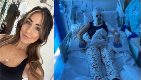 ГРЕЈАЛИЦА ЈОЈ ЕКСПЛОДИРАЛА У ЛИЦЕ: Девојка задобила језиве повреде, лекари морали да је уведу у кому ГРЕЈАЛИЦА ЈОЈ ЕКСПЛОДИРАЛА У ЛИЦЕ: Девојка задобила језиве повреде, лекари морали да је уведу у кому
