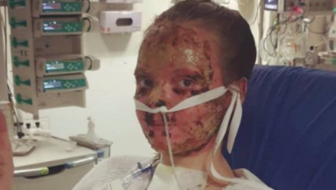 LICE JOJ POTPUNO IZGORELO U POŽARU: Studentkinja proživela pakao, mislila da će je momak ostaviti (FOTO) LICE JOJ POTPUNO IZGORELO U POŽARU: Studentkinja proživela pakao, mislila da će je momak ostaviti (FOTO)