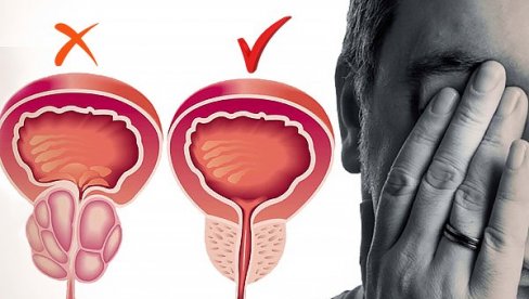 UVEĆANJE PROSTATE ZAVISI OD GODINA STAROSTI: Tulijum laser od 200 vati isparava prostatu bez obzira na njen obim