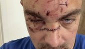 УЗНЕМИРУЈУЋЕ! Овако изгледају језиве повреде које је Карлик Џонс нанео човеку флашом (ФОТО)
