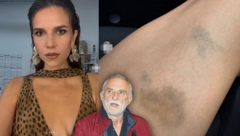 SVE IZNELA JAVNO Lazina Anica objavila fotografije u ogromnim modricama: Boli! (FOTO) SVE IZNELA JAVNO Lazina Anica objavila fotografije u ogromnim modricama: Boli! (FOTO)