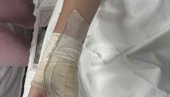 ДЕЧАКУ (14) ИЗ НИША АМПУТИРАН ДЕО ПРСТА: Мајка тврди да су га шипком претукла четворица малолетника