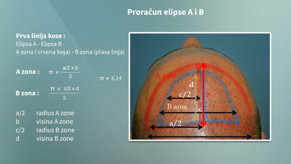 АХТ метод: Нова ера у трансплантацији косе”