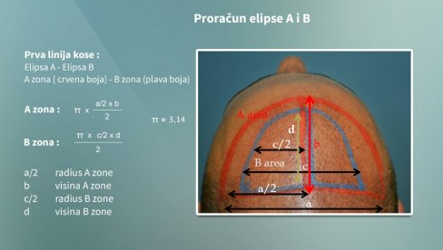 AHT metod: Nova era u transplantaciji kose”
