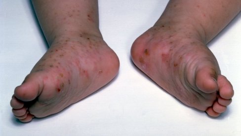 ДОДИР ЈЕ ДОВОЉАН ДА СЕ ЗАРАЗИТЕ: Букнула шуга у српском комшилуку