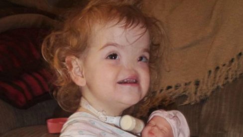 ПРВА БЕБА РОЂЕНА БЕЗ НОСА: Морала да дише на уста, а данас има 12 године и ево како изгледа (ФОТО)