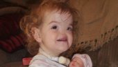 ПРВА БЕБА РОЂЕНА БЕЗ НОСА: Морала да дише на уста, а данас има 12 године и ево како изгледа (ФОТО)
