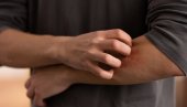 NEKAD JE ČAK ZNAK I UNUTRAŠNJIH BOLESTI: Ne zanemarujte kada vas svrbi koža, možda imate neke od ovih problema